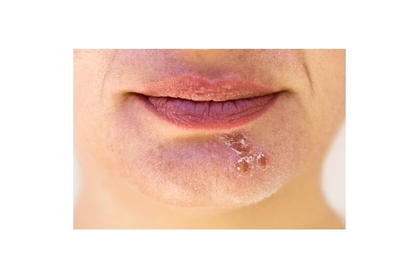 Domowe sposoby na opryszczkę - jak pozbyć się jej w jeden dzień?