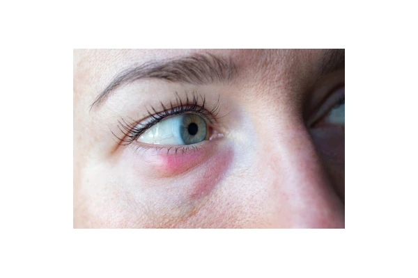 Jęczmień na oku - jak się go pozbyć?