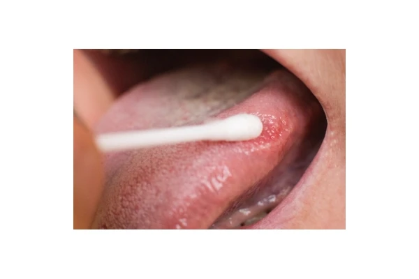 Pleśniawki u niemowlaka: zapobieganie, objawy i leczenie