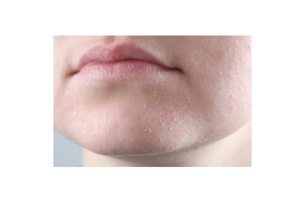 Sposoby na suchą skórę - jak poradzić sobie z tym problemem?