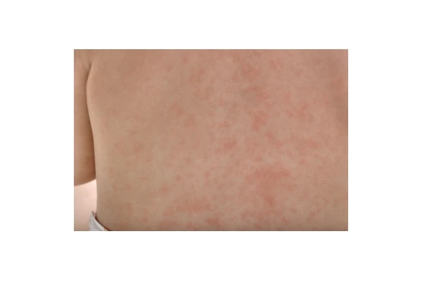 Trzydniówka (rumień nagły) u dzieci i dorosłych - czym się objawia i jak leczyć?