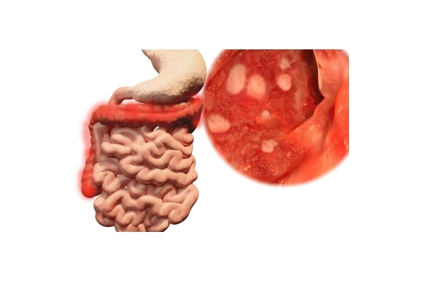 Wrzodziejące zapalenie jelita grubego - przyczyny, objawy i leczenie