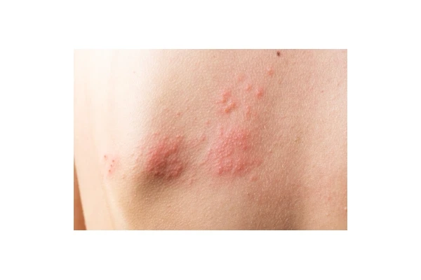 Wysypka na ciele - jakie mogą być jej powody? Jak sobie z nią radzić?