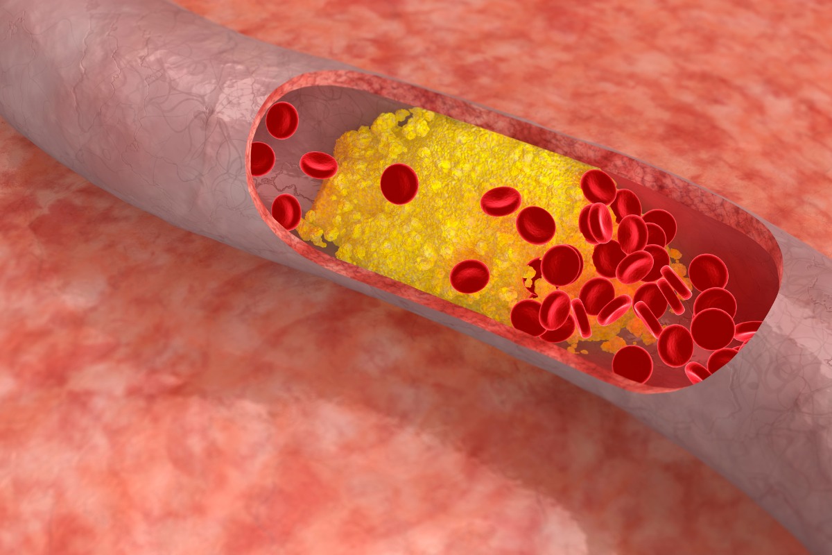 żyła - cholesterol wizualizacja