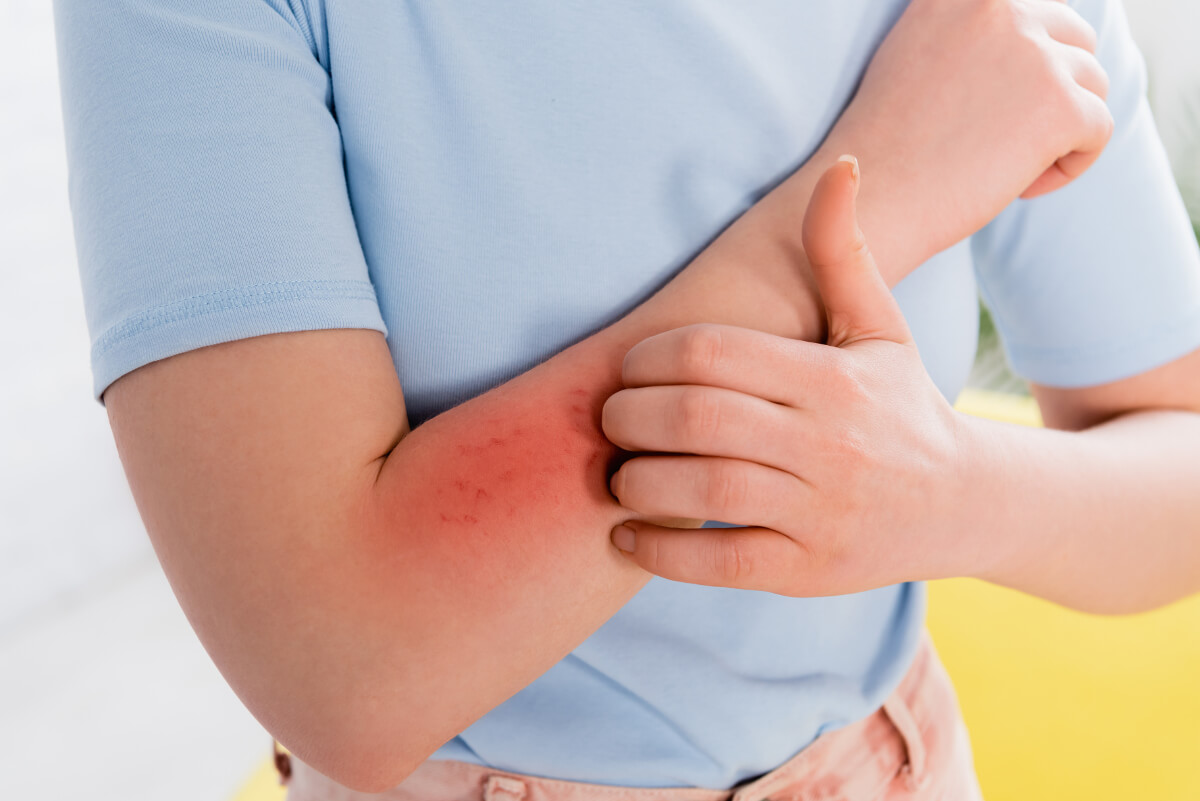 objawy alergii pokarmowej, zaczerwieniona i swędząca prawa ręka