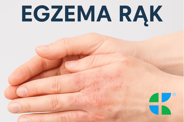 Egzema rąk - jak łagodzić objawy i dbać o skórę dłoni?